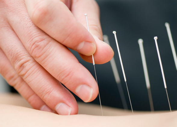 Acupuncture needles in patient's back
