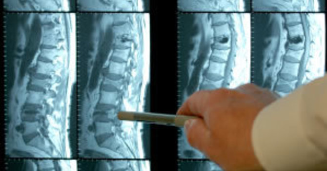 Why you probably don’t need an MRI for low back pain image