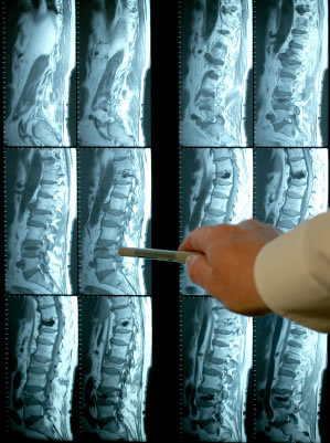 X-ray of lumbar lower back MRI scan