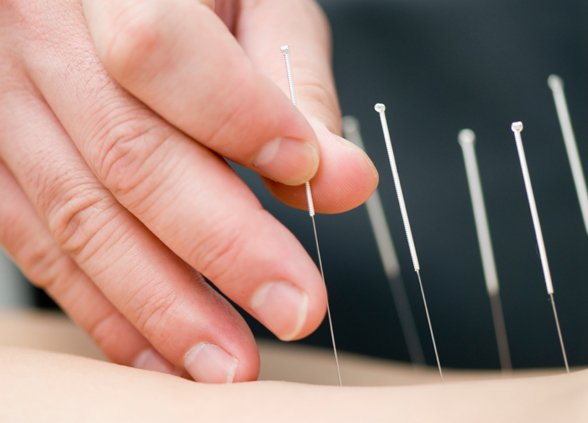 Acupuncture needles